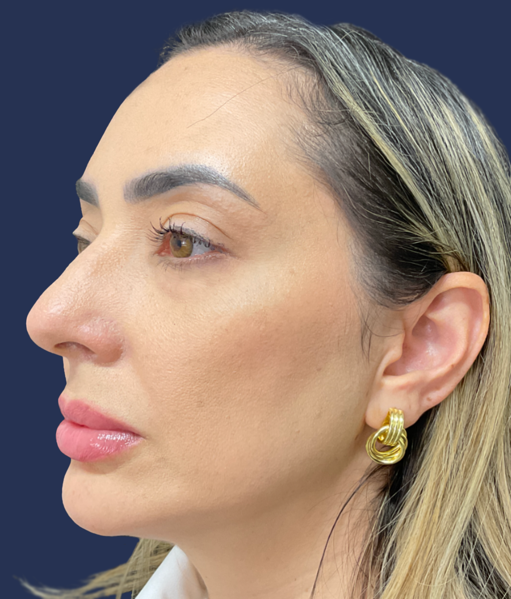 Jawline results after Lipoderma