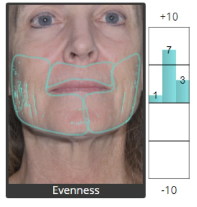 Skin evenness analysis after restoration
