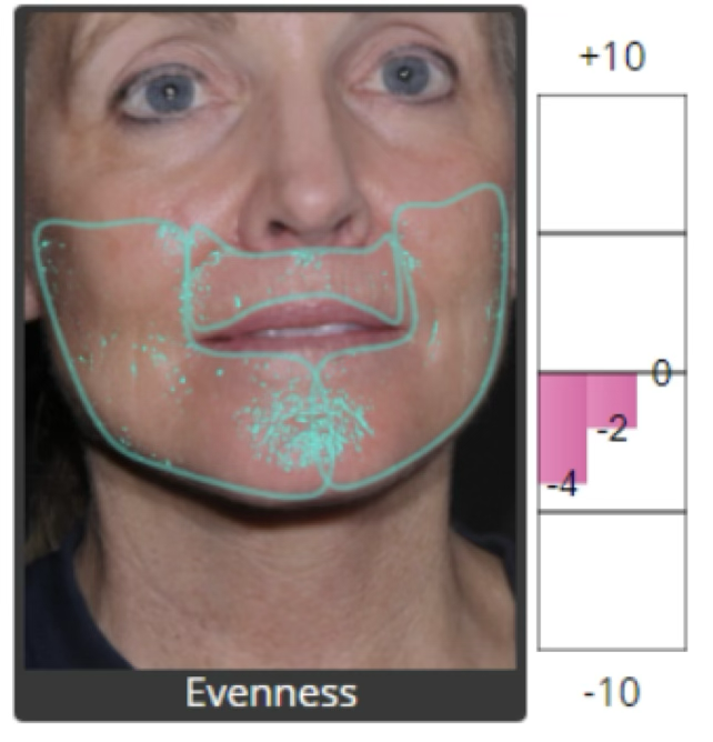 Skin evenness analysis before restoration