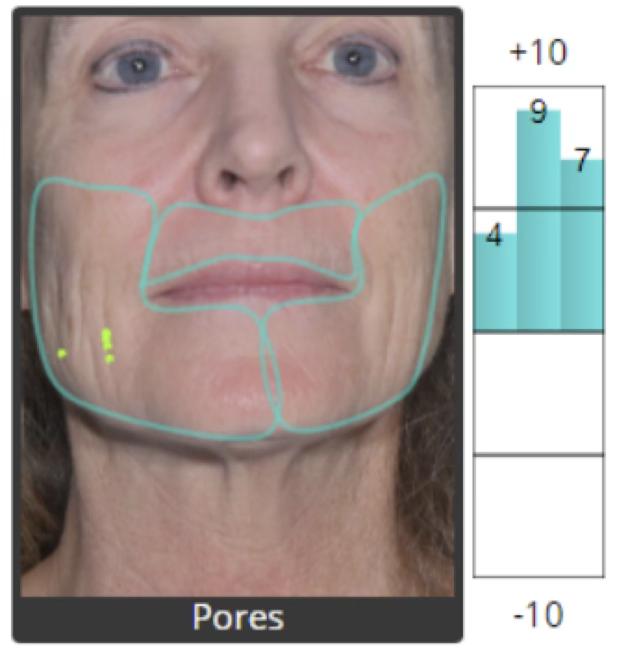 Pore visibility analysis after restoration