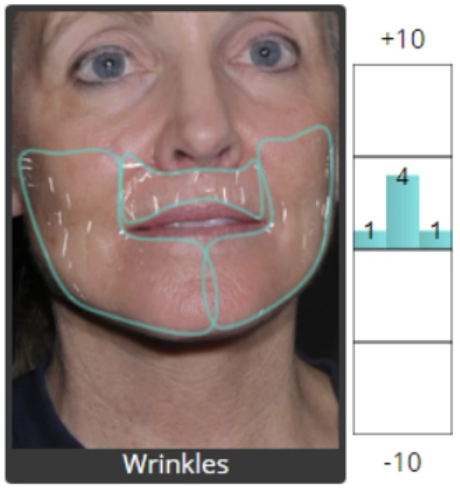 Wrinkle analysis after restoration