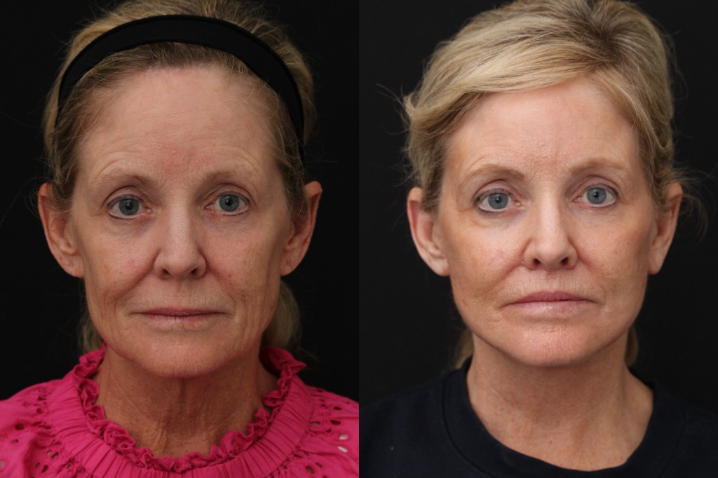 Clinical before and after portraits showing midface volume restoration